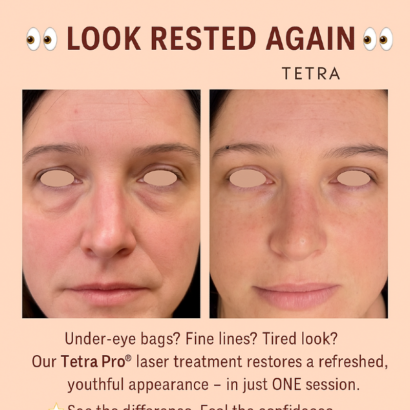 CoolPeel ( CO2 Laser: Tetra Pro)