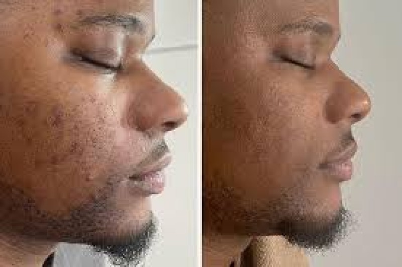 Laser pigmentaire (taches)