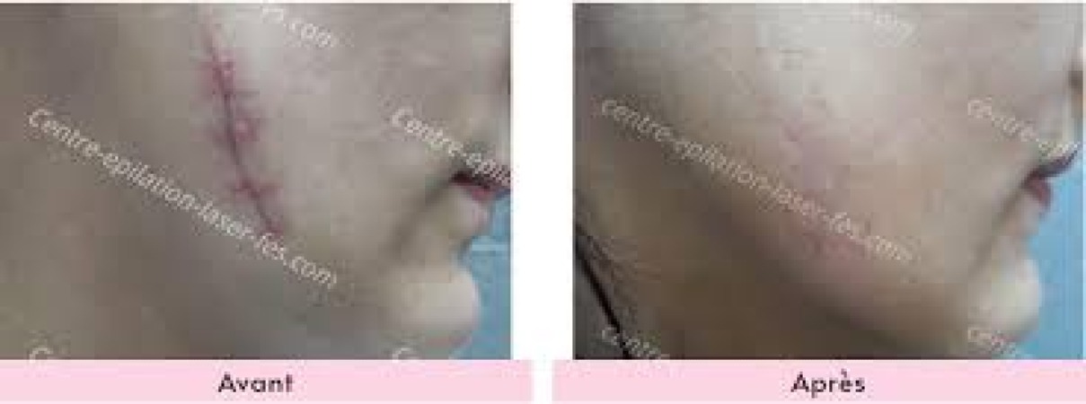 Traitement laser des cicatrices