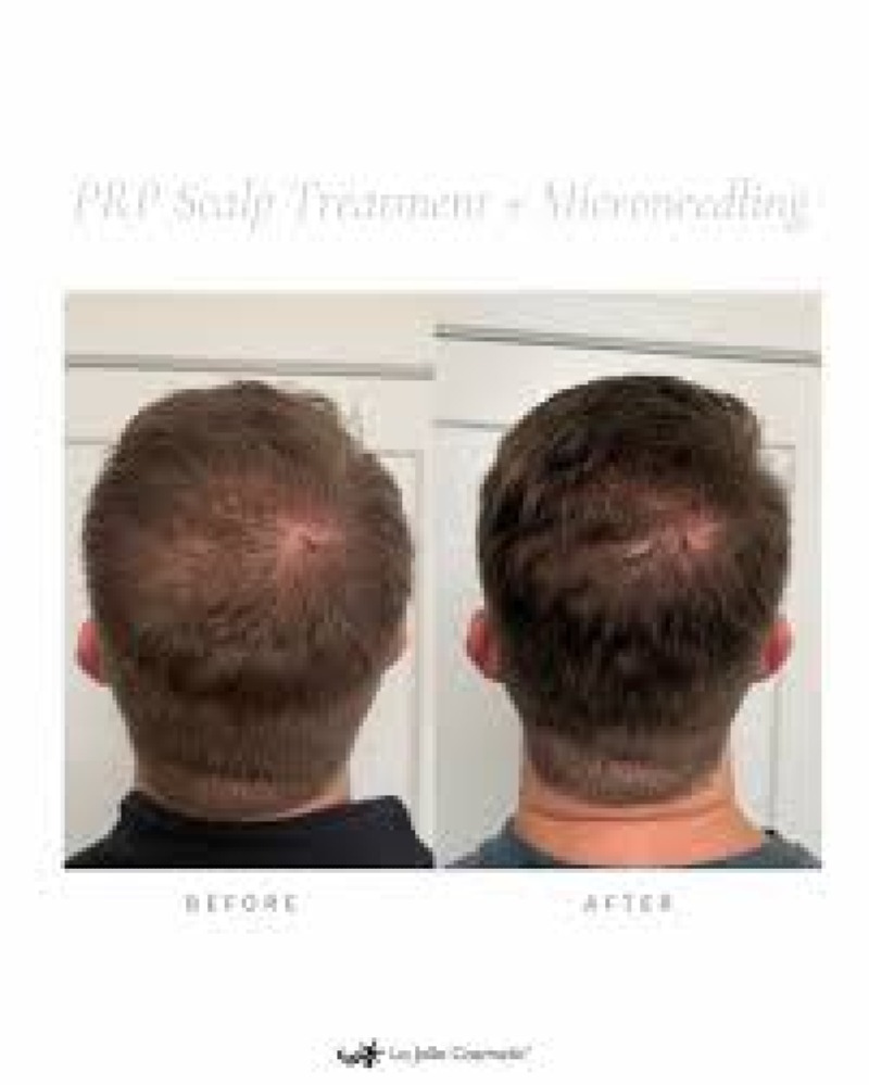 Soin de microneedling pour la regeneration de la peau, clinique GLIF Medical Montreal