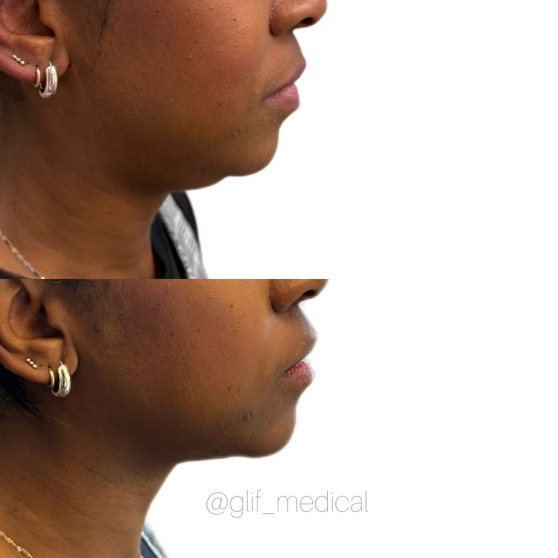 Traitement de reduction du double menton au laser Ultraformer, clinique GLIF Medical Montreal