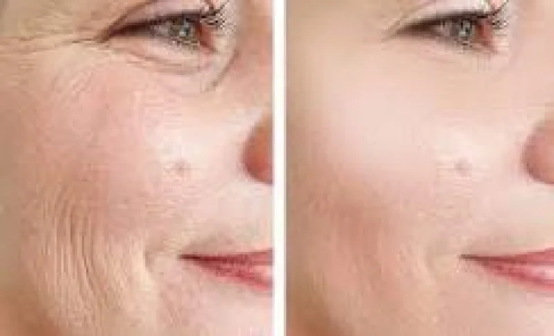 Photo avant/apres illustrant l hydratation cutanee obtenue avec un traitement de skinbooster a base d acide hyaluronique